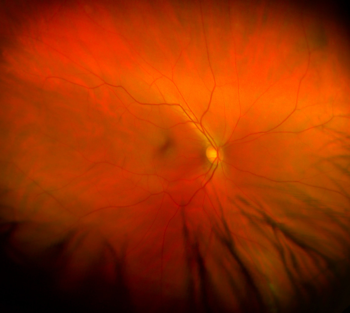 Предвестник диабетической ретинопатии