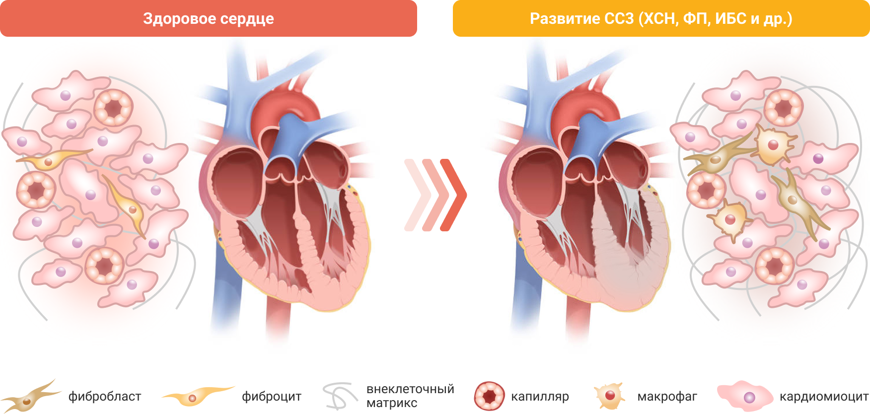 Гиперактивация МКР в сердце