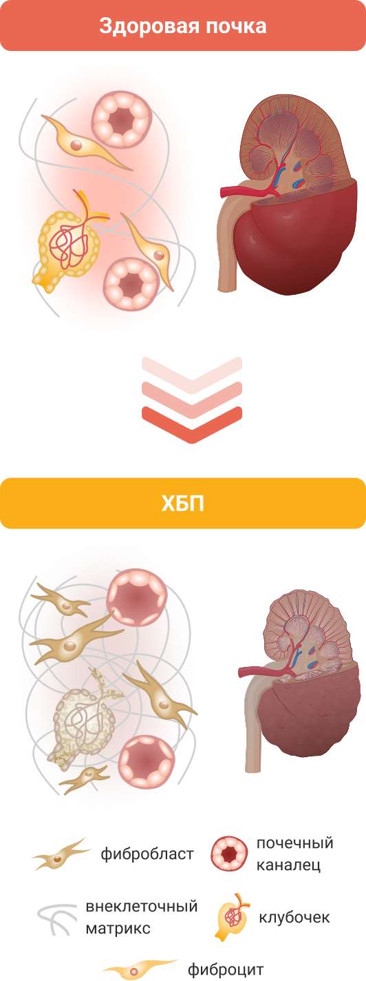 Гиперактивация МКР в почках